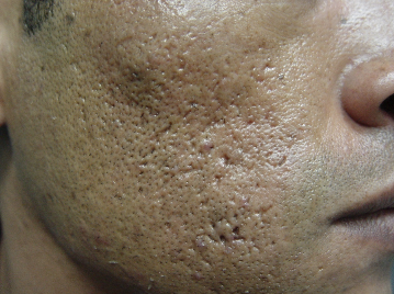 Enlarged Pores Before Treatment